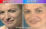 30 Second Facelift